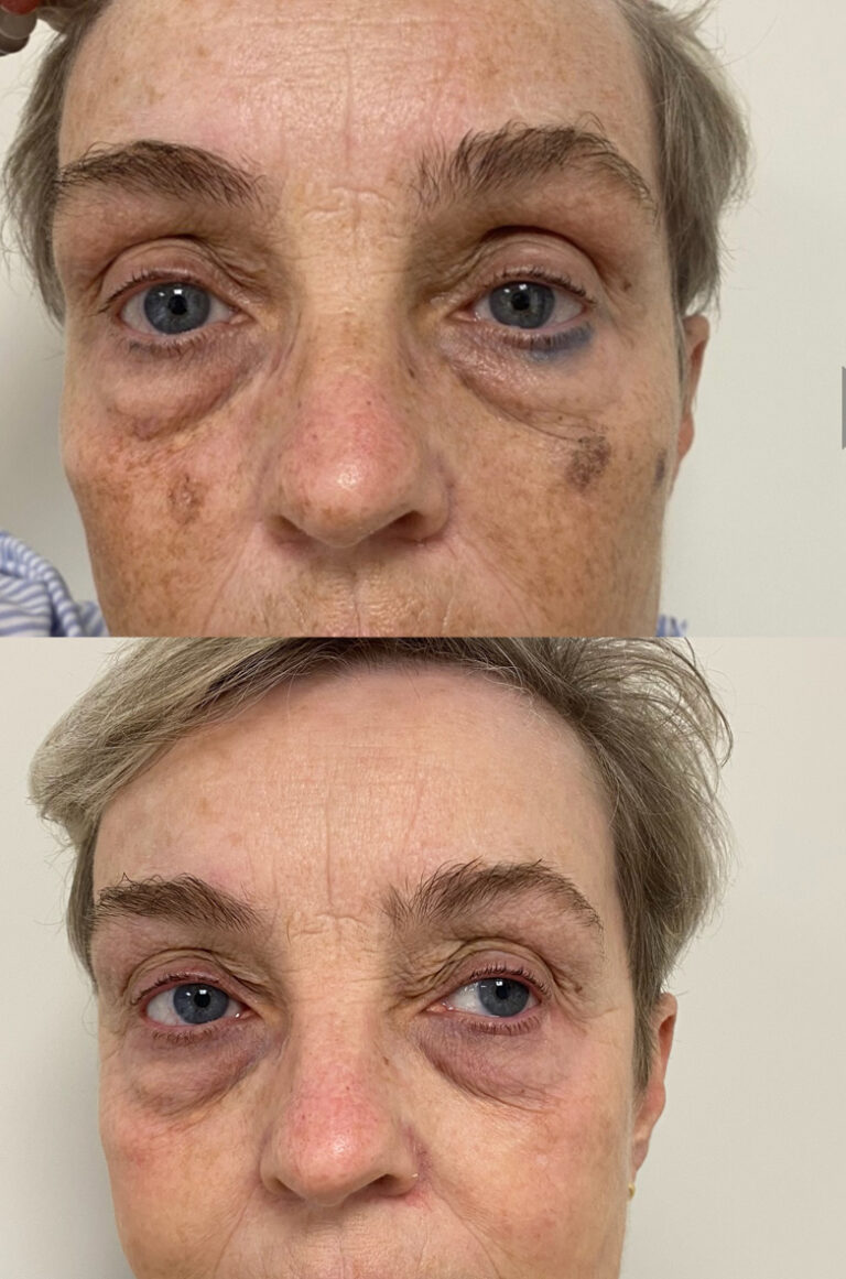 foer-efter-1.jpg